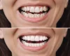 Composite Bonding: Unveiling the Secrets to Long-Term Durability