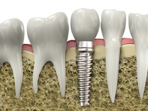 The Hidden Benefits of Dental Implants for Active Lifestyles